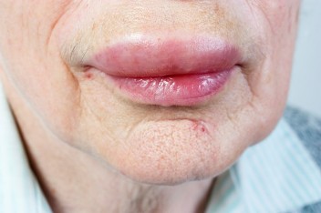 Angioedema without Hives